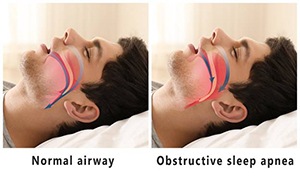 obstructive sleep apnea animation